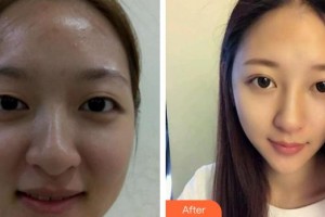 潛江亞美醫(yī)療美容診所劉敏先整形價(jià)格表附切開雙眼皮案例展示