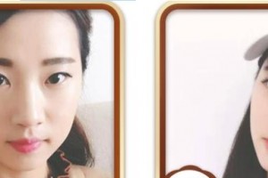 天門江岳醫(yī)療美容診所祝小麗整形價(jià)格表附定點(diǎn)雙眼皮案例展示