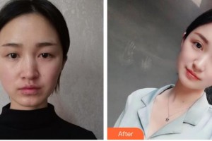 天門江岳醫(yī)療美容診所李龍整形價(jià)格表附眼部綜合案例展示