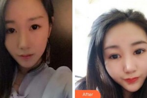 天門愛爾眼科醫(yī)院張新法整形價(jià)格表附眼部綜合案例展示