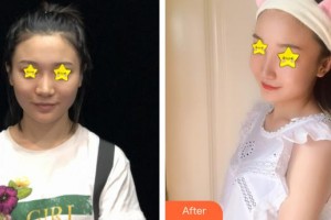 天門愛爾眼科醫(yī)院周君平整形價(jià)格表附眼部綜合案例展示