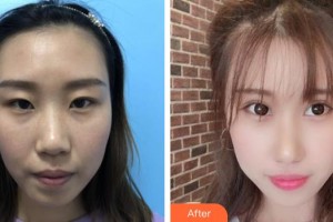 天門明保眼科醫(yī)院倪明保整形價(jià)格表附眼部綜合案例展示