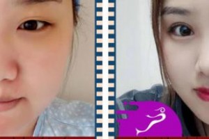 天門明保眼科醫(yī)院付德華整形價(jià)格表附眼部綜合案例展示