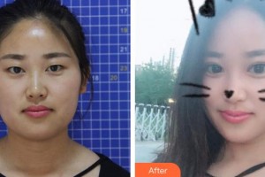 天門愛爾眼科醫(yī)院熊俊玲整形價(jià)格表附切開雙眼皮案例展示