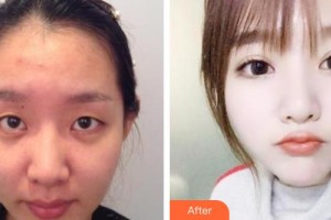 牡丹江第一人民醫(yī)院燒傷科姜月虎整形價(jià)格表附眼部綜合案例展示