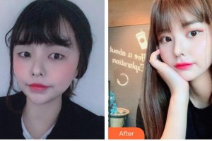 牡丹江北方醫(yī)院整形美容外科朱克文整形價(jià)格表附眼部綜合案例展示