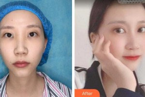 牡丹江美神醫(yī)療美容診所王玉梅整形價(jià)格表附眼部綜合案例展示