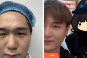 萍鄉(xiāng)漢和醫(yī)院美容整形中心唐家訓(xùn)整形價(jià)格表附開內(nèi)眼角案例展示