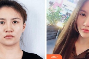 萍鄉(xiāng)市人民醫(yī)院美容整形科譚昶整形價(jià)格表附眼部綜合案例展示