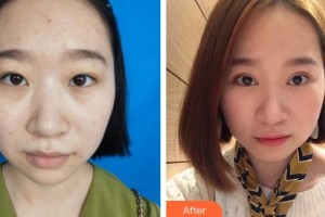 萍鄉(xiāng)優(yōu)美醫(yī)療美容門診部蔡豐任整形價(jià)格表附切開雙眼皮案例展示