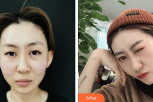 萍鄉(xiāng)星悅醫(yī)療美容診所嚴(yán)友才整形價(jià)格表附埋線提升案例展示