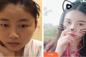 萍鄉(xiāng)愛爾眼科醫(yī)院胡發(fā)整形價(jià)格表附切開雙眼皮案例展示