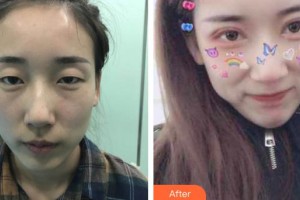 萍鄉(xiāng)愛爾眼科醫(yī)院楊明整形價(jià)格表附切開雙眼皮案例展示