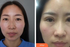 萍鄉(xiāng)市第二人民醫(yī)院眼科徐瓊整形價(jià)格表附切開雙眼皮案例展示