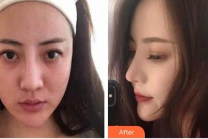 九江圣嘉麗醫(yī)療美容門診部胡南整形價(jià)格表附鼻修復(fù)案例展示