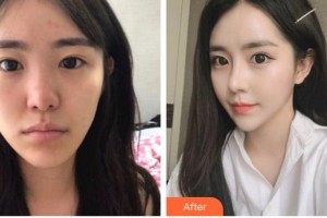 九江學(xué)院附屬醫(yī)院整形美容科詹太國整形價(jià)格表附鼻部綜合案例展示