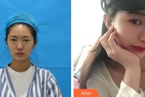 九江市婦幼保健院眼科唐衛(wèi)華整形價(jià)格表附鼻部綜合案例展示