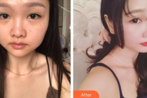 九江瑞麗醫(yī)療美容醫(yī)院萬成整形價(jià)格表附肋軟骨隆鼻案例展示