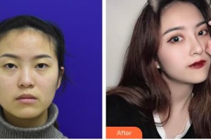 九江風(fēng)華醫(yī)療美容門診部宋志剛整形價(jià)格表附鼻部綜合案例展示