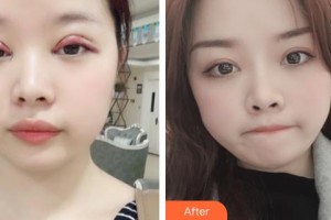 九江愛爾中山眼科醫(yī)院高崇惠整形價(jià)格表附切開雙眼皮案例展示