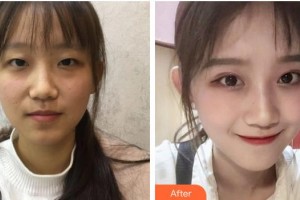 九江愛爾中山眼科醫(yī)院李紅鳴整形價(jià)格表附切開雙眼皮案例展示