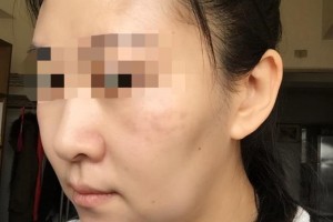 贛州華美醫(yī)療美容門診部劉兵整形價格表附面部年輕化案例展示