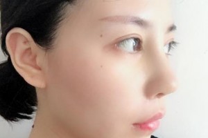 贛州華美醫(yī)療美容門診部覃潔敏整形價格表附隆鼻案例展示