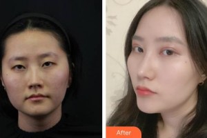 宜春學(xué)院整形美容醫(yī)院白承根整形價(jià)格表附切開雙眼皮案例展示