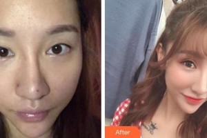 宜春艾萊芙醫(yī)療美容門診部付曉紅整形價(jià)格表附切開雙眼皮案例展示