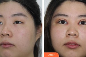 宜春韓美醫(yī)療美容門診部余志亮整形價(jià)格表附切開雙眼皮案例展示