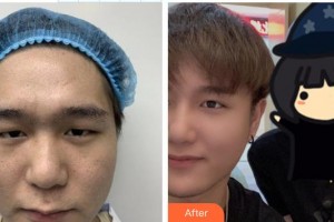 宜春學(xué)院整形美容醫(yī)院周金娟整形價(jià)格表附開內(nèi)眼角案例展示