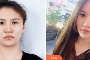 宜春華美醫(yī)療美容醫(yī)院王明華整形價(jià)格表附埋線雙眼皮案例展示