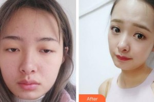 宜春瑞麗整形美容門診部趙杰發(fā)整形價(jià)格表附切開雙眼皮案例展示