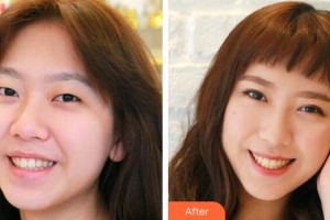 宜春學(xué)院整形美容醫(yī)院曹寒秀整形價(jià)格表附切開雙眼皮案例展示