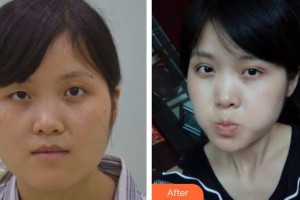 宜春學(xué)院整形美容醫(yī)院彭芳麗整形價(jià)格表附切開雙眼皮案例展示
