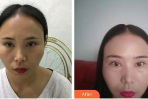 宜春學(xué)院整形美容醫(yī)院張其亮整形價(jià)格表附開外眼角案例展示