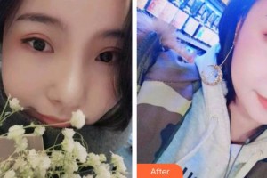 宜春韓美醫(yī)療美容門診部劉興達(dá)整形價(jià)格表附牙齒隱形矯正案例展示