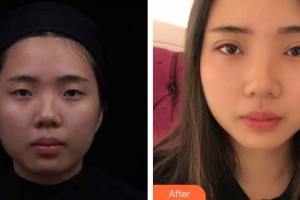 宜春天澤美容醫(yī)院彭銀全整形價格表附眼部綜合案例展示