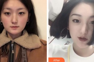 宜春愛爾眼科醫(yī)院張忠勝整形價(jià)格表附定點(diǎn)雙眼皮案例展示