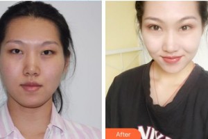 宜春愛爾眼科醫(yī)院周益龍整形價(jià)格表附眼部綜合案例展示