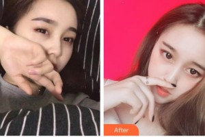 宜春愛爾眼科醫(yī)院鄢濤整形價(jià)格表附眼部綜合案例展示