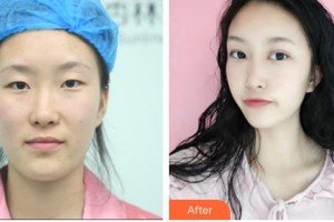 宜春愛爾眼科醫(yī)院譚成整形價格表附眼部綜合案例展示