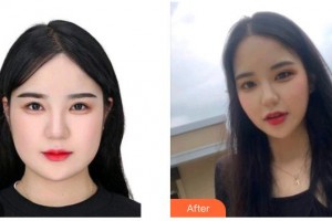 撫州美萊爾醫(yī)療美容門診部熊德成整形價格表附眼部綜合案例展示