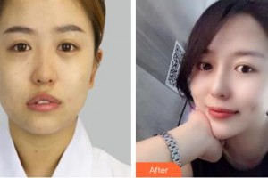 撫州江醫(yī)生醫(yī)療美容門診部江娟萍整形價格表附眼部修復案例展示