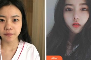 撫州韓尚醫(yī)療美容門診部戴凌欽整形價格表附切開雙眼皮案例展示