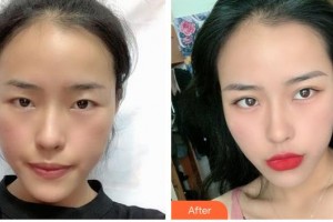 撫州江醫(yī)生醫(yī)療美容門診部周璇整形價格表附切開雙眼皮案例展示