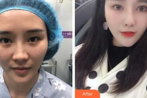 上饒尚美醫(yī)療美容門診部柯小洪整形價格表附眼部綜合案例展示