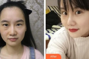 上饒市人民醫(yī)院燒傷整形外科周方政整形價格表附眼部綜合案例展示