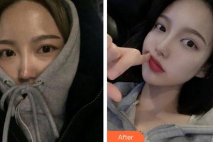 上饒尚美醫(yī)療美容門診部李海華整形價格表附鼻部綜合案例展示