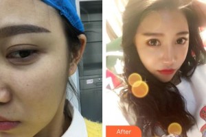 上饒尚美醫(yī)療美容門診部王功槐整形價格表附埋線提升案例展示